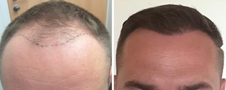 Peut On Faire L Amour Après Une Greffe De Cheveux Greffe de cheveux : un résultat surprenant après quelques mois