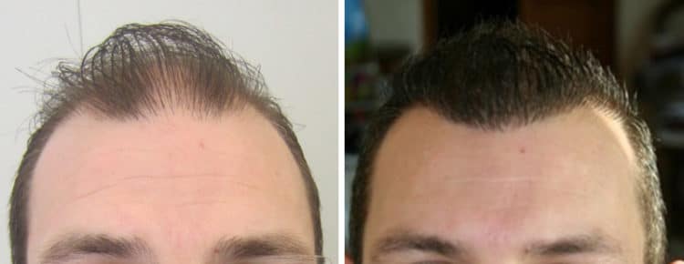 Peut On Faire L Amour Après Une Greffe De Cheveux Greffe de cheveux : un résultat surprenant après quelques mois